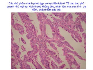Các nhú phân nhánh phức tạp, có trục liên kết rõ. Tế bào bao phủ
quanh nhú loại trụ, kích thước không đều, nhân lớn, mất cực tính, ưa
kiềm, chất nhiễm sắc thô.
 