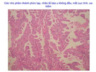 Các nhú phân nhánh phức tạp, nhân tế bào u không đều, mất cực tính, ưa
kiềm
 