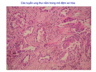 Các tuyến ung thư nằm trong mô đệm xơ hóa
 