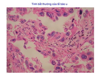 Tính bất thường của tế bào u
 