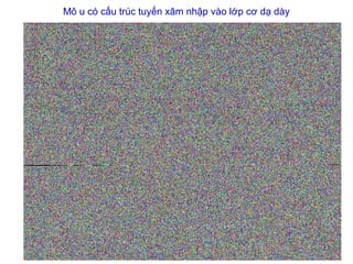 Mô u có cấu trúc tuyến xâm nhập vào lớp cơ dạ dày
 