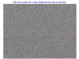 Cấu trúc tuyến mô u xâm nhập phá hủy lớp cơ dạ dày
 