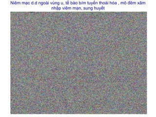 Niêm mạc d.d ngoài vùng u, tế bào b/m tuyến thoái hóa , mô đêm xâm
nhập viêm mạn, sung huyết
 