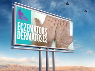 Eczematous Dermatoses Part 1