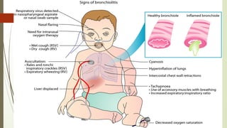 Comprehensive Overview of Viral Bronchiolitis in Infants: Diagnosis ...