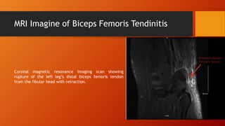 MRI Imagine of Biceps Femoris Tendinitis
Coronal magnetic resonance imaging scan showing
rupture of the left leg’s distal biceps femoris tendon
from the fibular head with retraction.
 