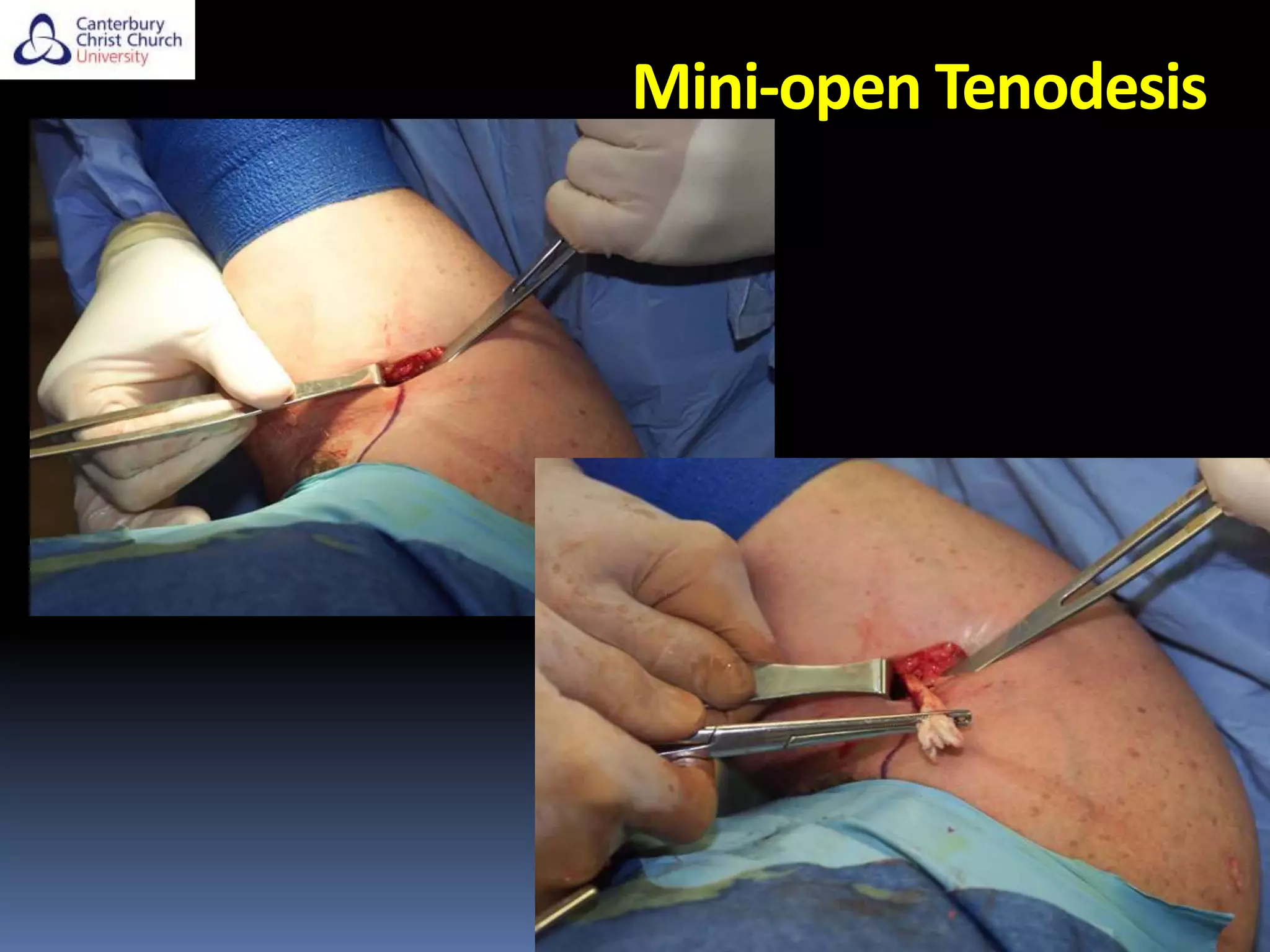 Mini-open Tenodesis
 