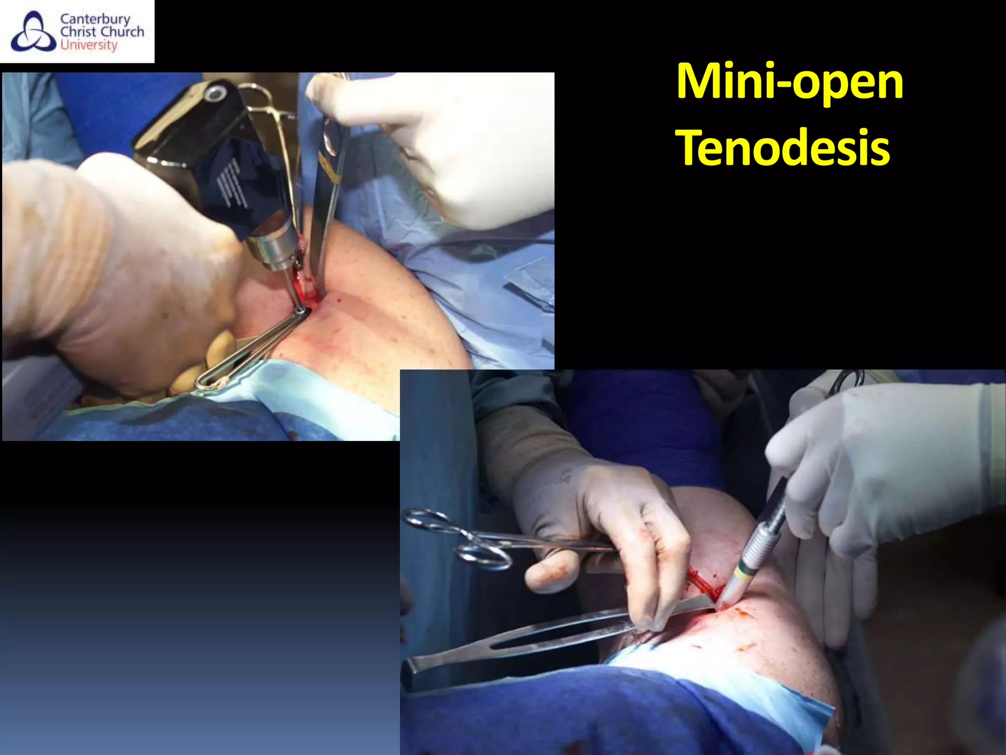 Mini-open
Tenodesis
 