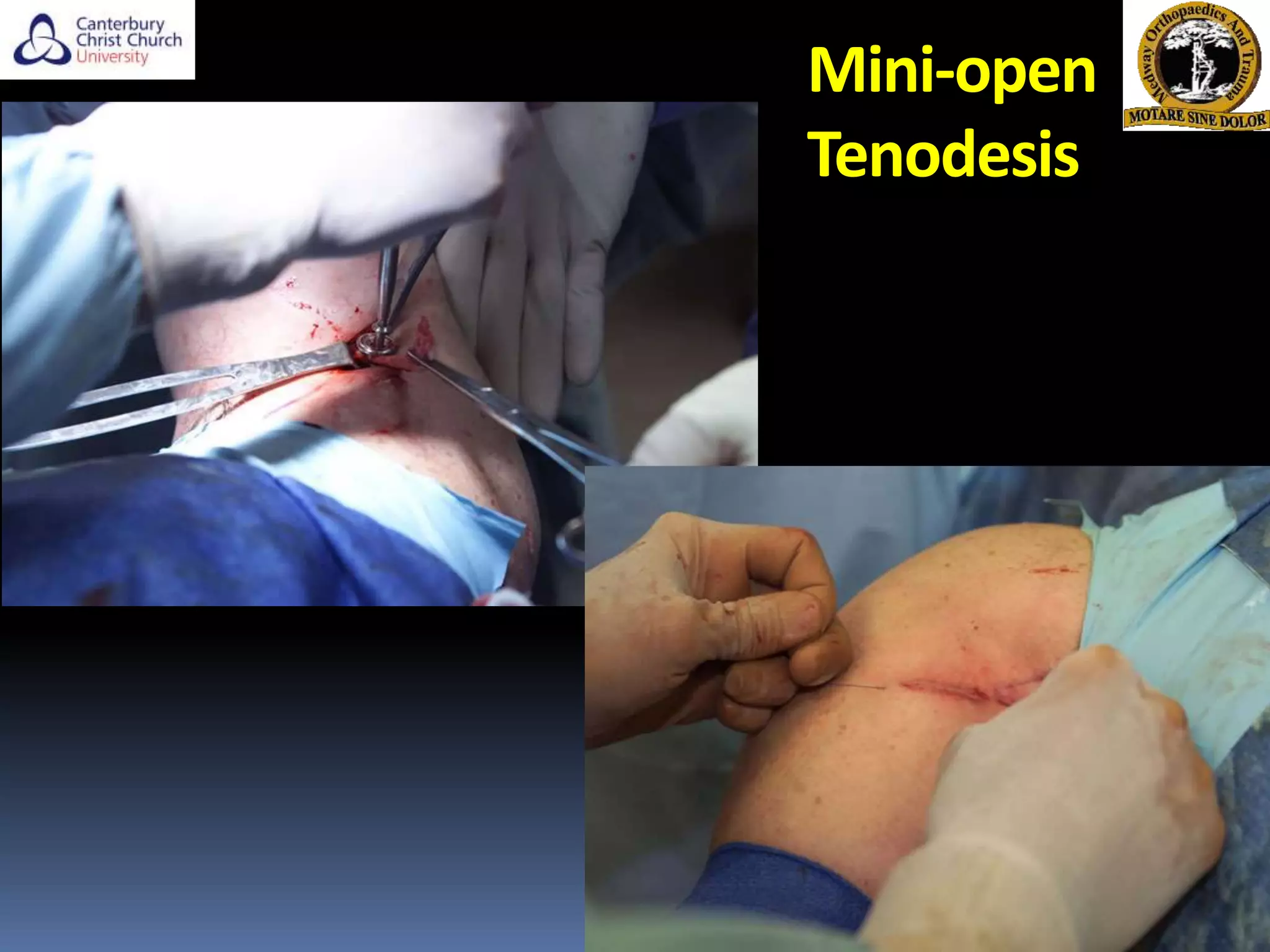 Mini-open
Tenodesis
 