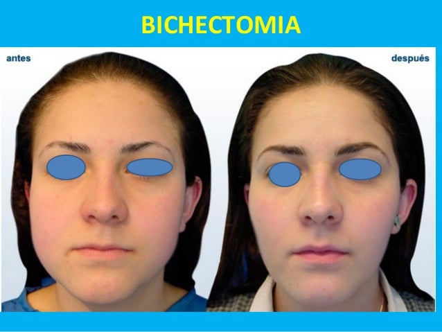 Bichectomia Y Lipo Papada Slideshare
