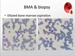 Bma Inj Image Biclonal gammopathy extramedullary disease case presentation | PPTX