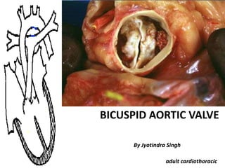 Bicuspid aortic valve | PPTX