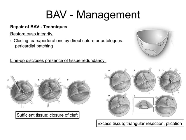 Bicuspid Aortic Valve Pptx Bicuspid Aortic Valve Pptx