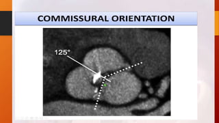 Bicuspid aortic valve 