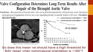 Bicuspid aortic valve 