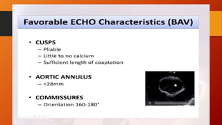Bicuspid aortic valve 
