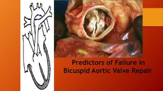 Predictors of Failure in
Bicuspid Aortic Valve Repair
 