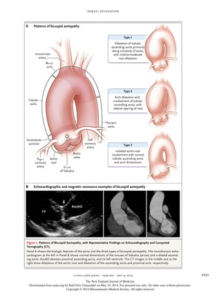 Aortic Dilatation
n engl j med 370;20 nejm.org may 15, 2014 1921
Innominate
artery
Aortic
arch
Tubular
aorta
artery
AorticAortic
Thoracic
aorta
Sinotubular
junction
Sinus
of Valsalva
Aortic
root
Aortic
valve
Left
coronary
artery
AorticAortic
LeftLeft
Right
coronary
artery
RightRight
SinusSinus
Patterns of bicuspid aortopathyA
Type 1Type 1
Type 2
Type 3Type 3
Echocardiographic and magnetic resonance examples of bicuspid aortopathyB
Isolated aortic-root
involvement with normal
tubular ascending aorta
and arch dimensions
Arch dilatation with
involvement of tubular
ascending aorta, with
relative sparing of root
Dilatation of tubular
ascending aorta primarily
along convexity of aorta,
with mild-to-moderate
root dilatation
LV
AscAO
Figure 1. Patterns of Bicuspid Aortopathy, with Representative Findings on Echocardiography and Computed
Tomography (CT).
Panel A shows the biologic features of the aorta and the three types of bicuspid aortopathy. The transthoracic echo-
cardiogram at the left in Panel B shows normal dimensions of the sinuses of Valsalva (arrow) and a dilated ascend-
ing aorta. AscAO denotes proximal ascending aorta, and LV left ventricle. The CT images in the middle and at the
right show dilatation of the aortic root and dilatation of the ascending aorta and proximal arch, respectively.
The New England Journal of Medicine
Downloaded from nejm.org by Ralf Felix Trauzeddel on May 19, 2014. For personal use only. No other uses without permission.
Copyright © 2014 Massachusetts Medical Society. All rights reserved.
 