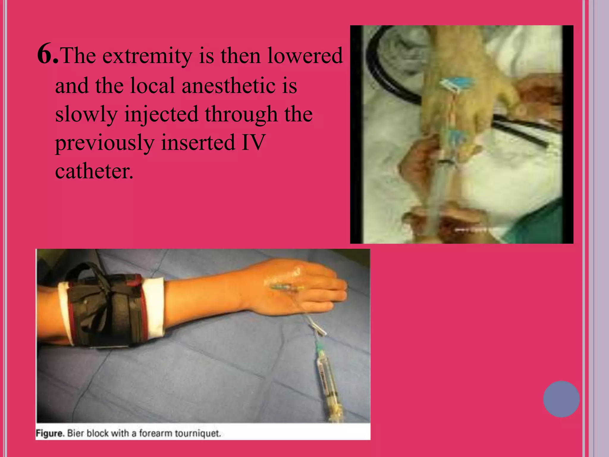 Bier block (intravenous regional anesthesia) PPT