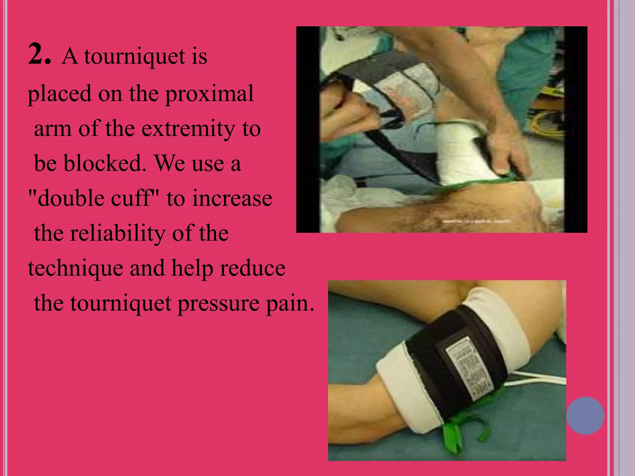 Biers Block Risks Bier block (intravenous regional anesthesia) | PPTX