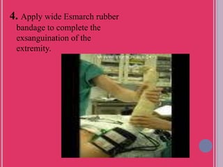 4. Apply wide Esmarch rubber
bandage to complete the
exsanguination of the
extremity.
 