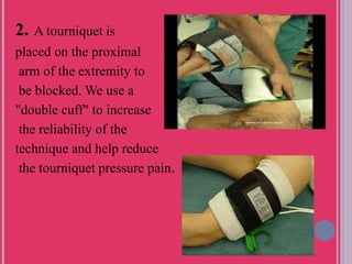 2. A tourniquet is
placed on the proximal
arm of the extremity to
be blocked. We use a
"double cuff" to increase
the reliability of the
technique and help reduce
the tourniquet pressure pain.
 