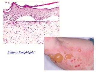 Bullous Pemphigoid
 