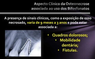 A presença de sinais clínicos, como a exposição de osso
   necrosado, varia de 9 meses a 3 anos e pode estar
                      associada a:

                           • Quadros dolorosos;
                              • Mobilidade
                                 dentária;
                               • Fístulas.
 