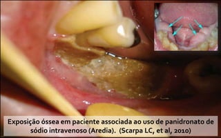 Exposição óssea em paciente associada ao uso de panidronato de
       sódio intravenoso (Aredia). (Scarpa LC, et al, 2010)
 