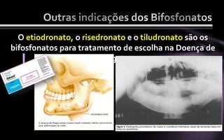 O etiodronato, o risedronato e o tiludronato são os
bifosfonatos para tratamento de escolha na Doença de
                         Paget
 