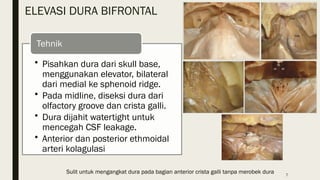 Transbasal Approach Bifrontal transbasal approach - 25 Agustus 2022 - RS AB PP.pptx