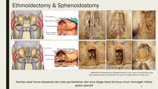 Transbasal Approach Bifrontal transbasal approach - 25 Agustus 2022 - RS AB PP.pptx