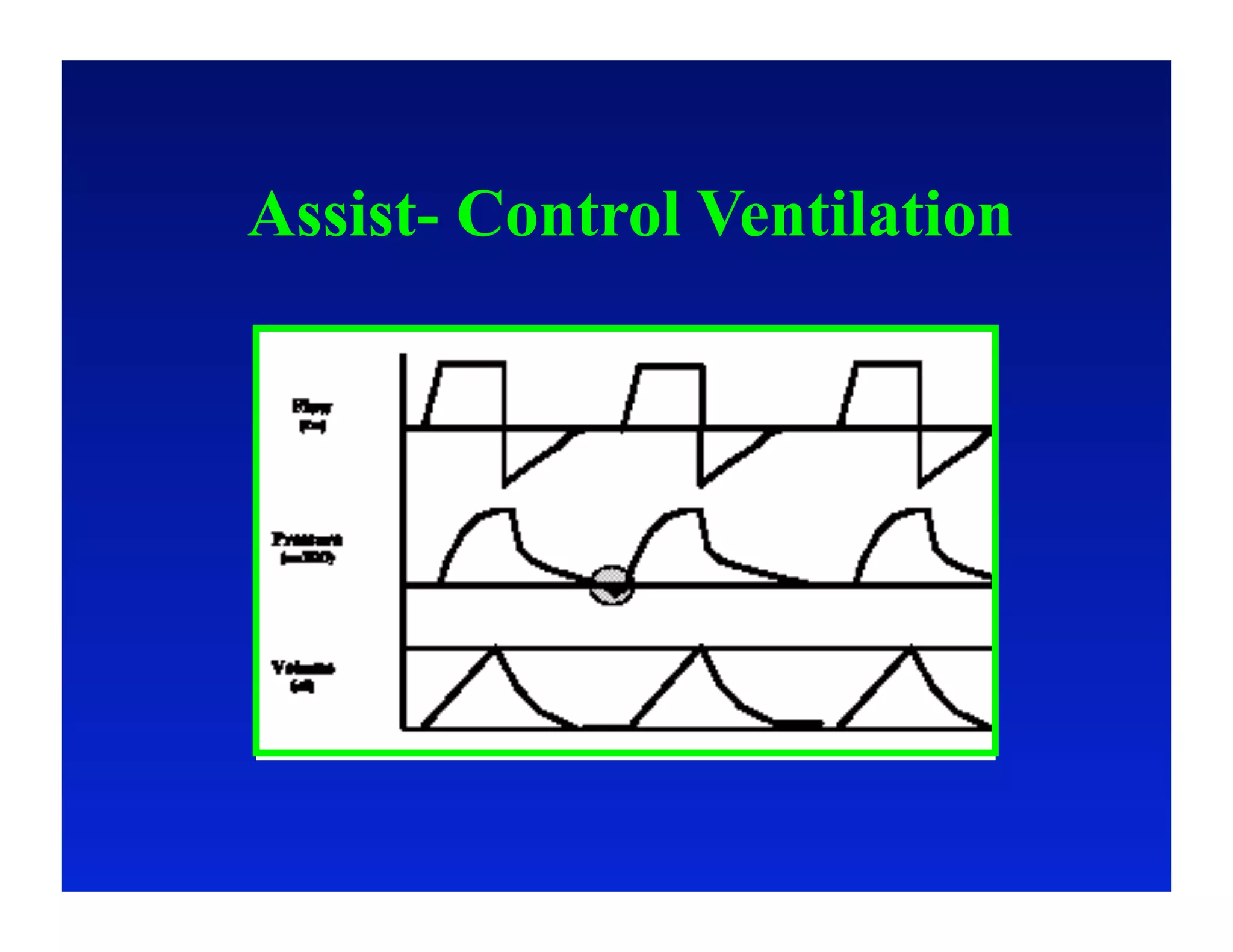 Assist- Control Ventilation
 