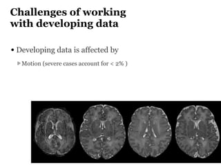 Challenges of working
with developing data
• Developing data is affected by
Motion (severe cases account for < 2% )
 