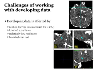 Challenges of working
with developing data
• Developing data is affected by
Motion (severe cases account for < 2% )
Limite...