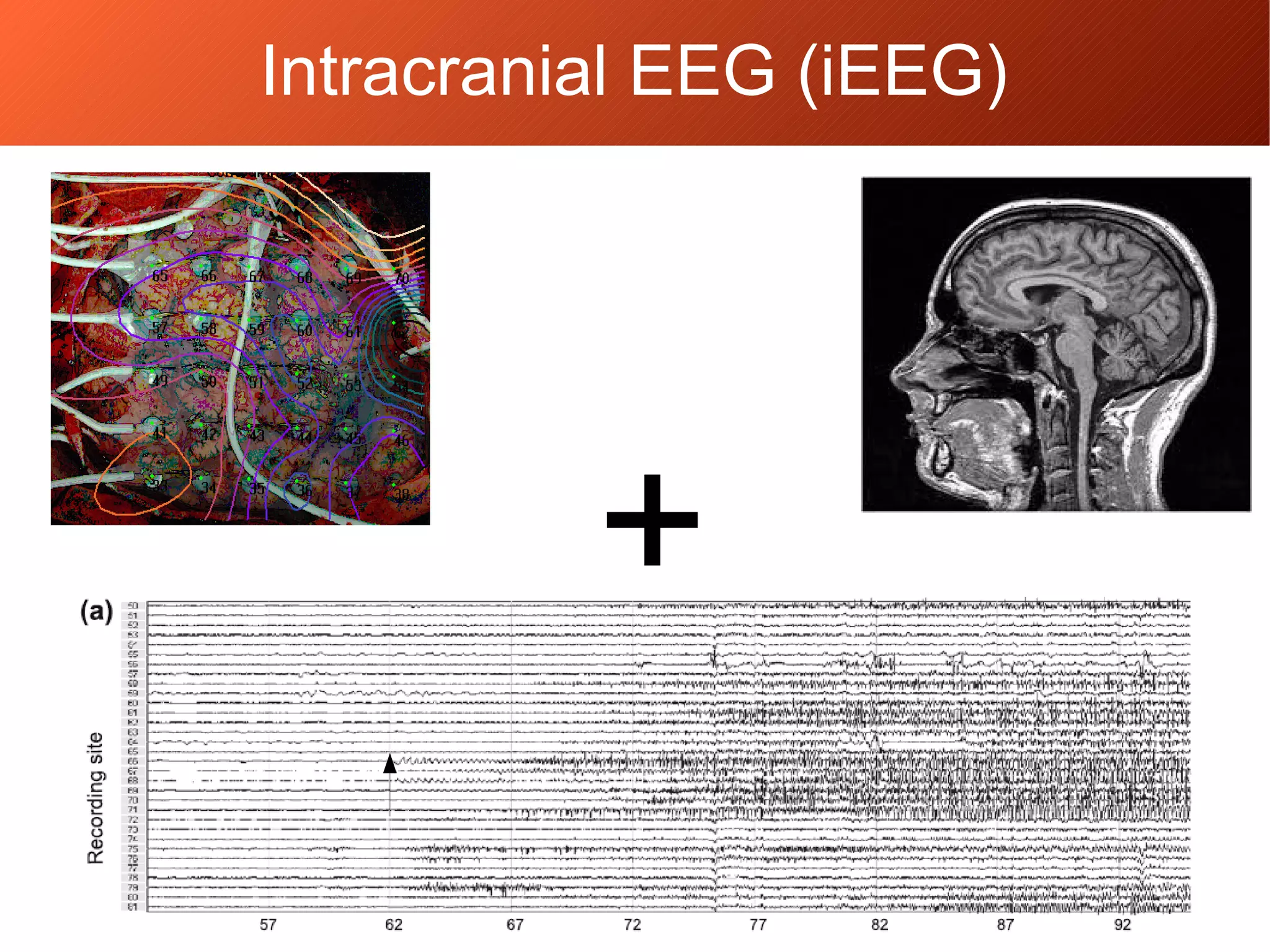 +
Intracranial EEG (iEEG)
 