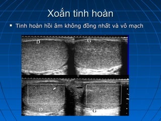Xoắn tinh hoànXoắn tinh hoàn
 Tinh hoàn hồi âm không đồng nhất và vô mạchTinh hoàn hồi âm không đồng nhất và vô mạch
 