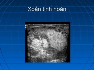 Xoắn tinh hoànXoắn tinh hoàn
 