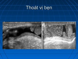 Thoát vị bẹnThoát vị bẹn
 