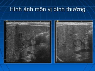 Hình ảnh môn vị bình thườngHình ảnh môn vị bình thường
 