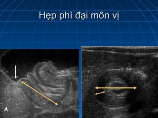 Hẹp phì đại môn vịHẹp phì đại môn vị
 