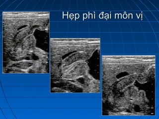 Hẹp phì đại môn vịHẹp phì đại môn vị
 