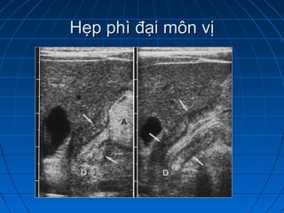 Hẹp phì đại môn vịHẹp phì đại môn vị
 