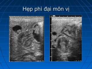 Hẹp phì đại môn vịHẹp phì đại môn vị
 