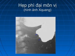 Hẹp phì đại môn vịHẹp phì đại môn vị
(hình ảnh Xquang)(hình ảnh Xquang)
 