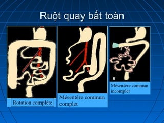 Ruột quay bất toànRuột quay bất toàn
 