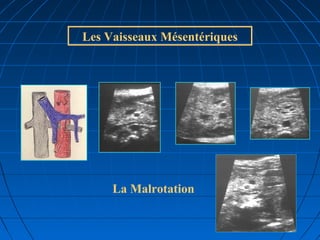 Les Vaisseaux Mésentériques
La Malrotation
 