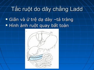 Tắc ruột do dây chằng LaddTắc ruột do dây chằng Ladd
 Giãn và ứ trệ dạ dày –tá tràngGiãn và ứ trệ dạ dày –tá tràng
 Hình ảnh ruột quay bất toànHình ảnh ruột quay bất toàn
 