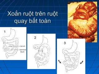 Xoắn ruột trên ruộtXoắn ruột trên ruột
quay bất toànquay bất toàn
 