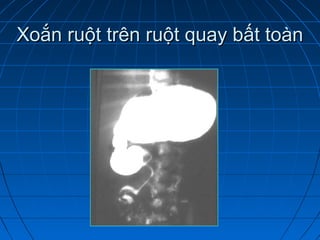 Xoắn ruột trên ruột quay bất toànXoắn ruột trên ruột quay bất toàn
 